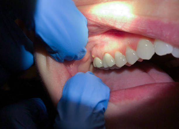 Best Emergency Treatment for Dental Infections or Abscesses in Curtice, OH